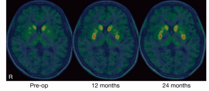 Japan’s Stem Cell Scientists Claim Breakthrough in Parkinson’s Treatment